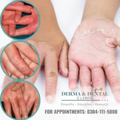 contact eczema