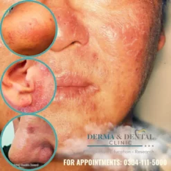 Find Relief from Chronic Actinic Dermatitis at Derma & Dental Clinic