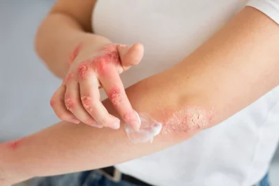Hands-Patient-Suffering-From-Psoriasis